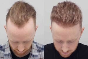 Hair Transplant Turkey